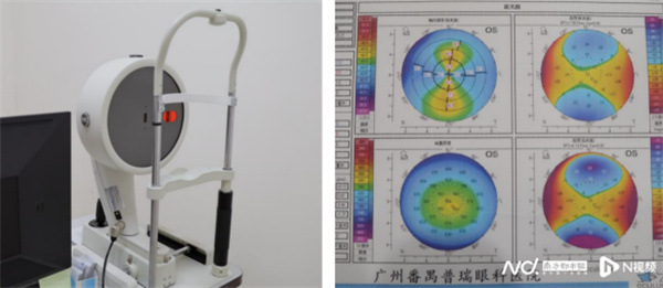 人工智能+医疗 刘泉教授：或辅助分析，初判能否近视手术